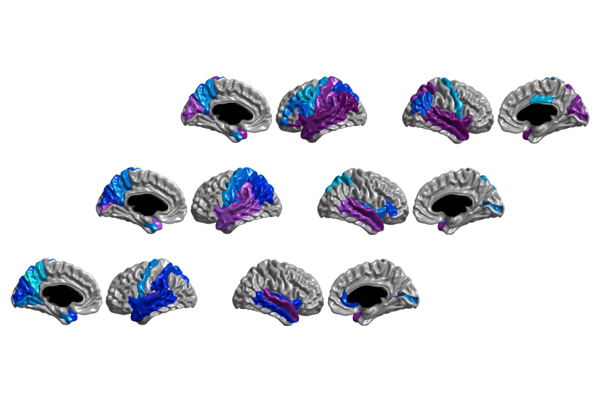 Structural anomalies (purple and blue) in the brains of babies with autism at 6 months (bottom row) become more widespread by 12 months (top row).