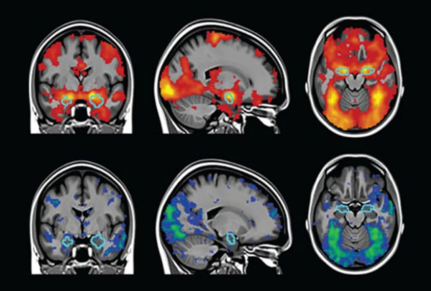 side, top and frontal views of human brains.