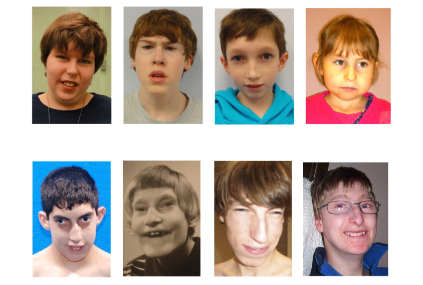 Grid of 8 portraits of children with characteristic facial features