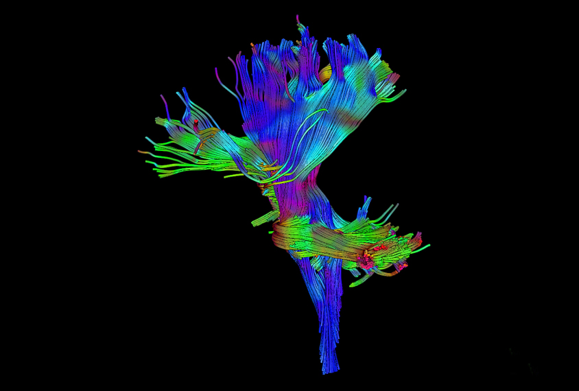 tructural images of autism brains rarely depict the brain stem.