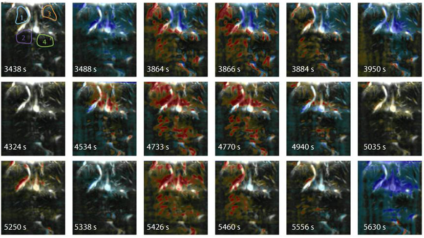 High-frequency sound waves reveal changes in blood flow that correspond to seizure activity.