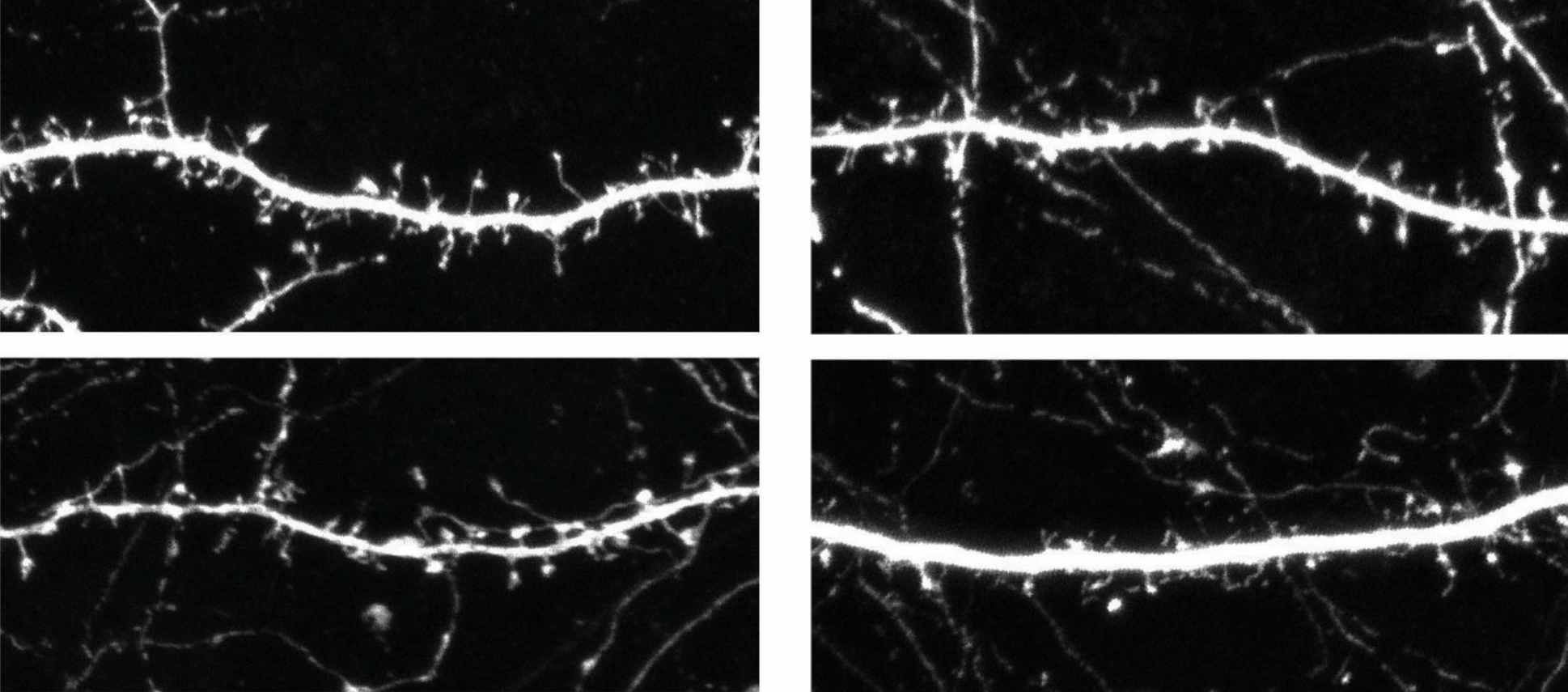 Neurons from mice missing OTUD7A (right) have fewer spines than do those from controls (left).