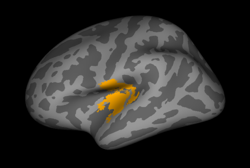 Three dimensional rendering of the human brain with yellow area showing a change in folding patterns.