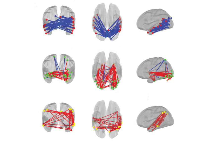 Three columns of brain images show patterns of brain connections.