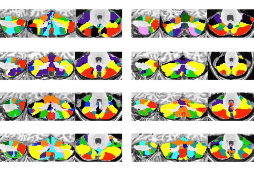 a series of brain images