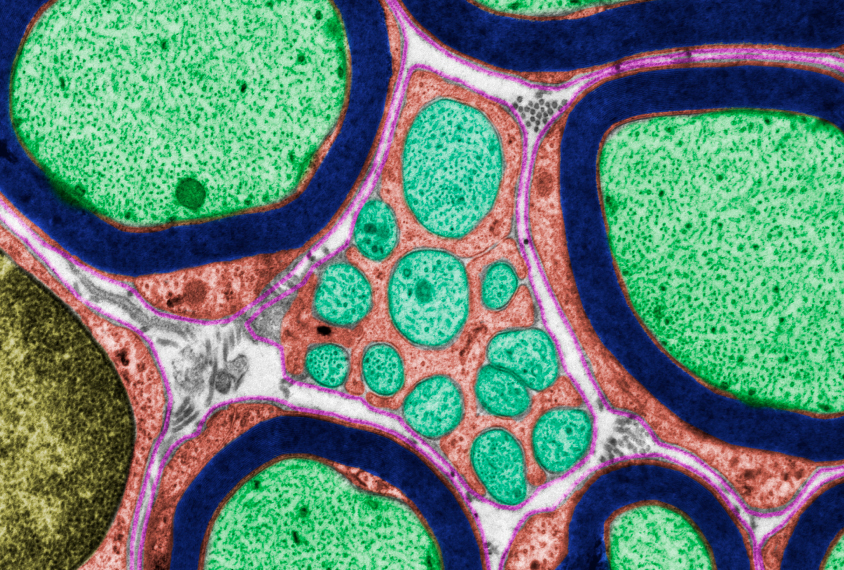 Coloured transmission electron micrograph (TEM) showing several unmyelinated (green) and myelinated (green with blue border) axons. Schwann cell cytoplasm is red and a nucleus (bottom left) is yellow. The pink lines are the basement membranes.