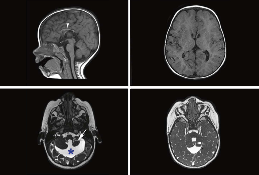 Brain MRIs showing injured blood vessels