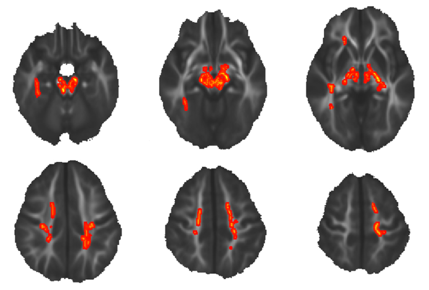group of six brain images from children show white matter, anomalies shown in red areas