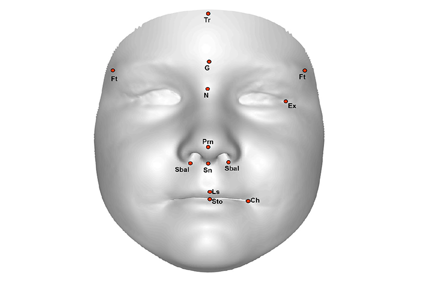 3D image of a child's face with coordinates to measure distances between features.