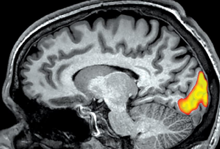 Side view of the human brain, area highlighted at the back of brain is activated by visual stimuli.