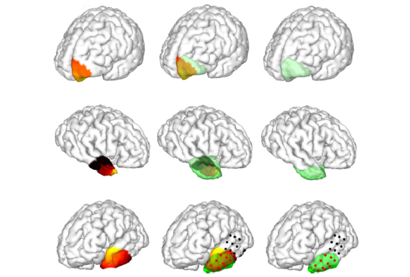 grid of brains with one area highlighted shows a potential source of a seizure