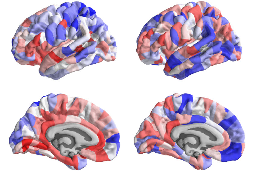 Brain images color-coded to show structural changes in autism.