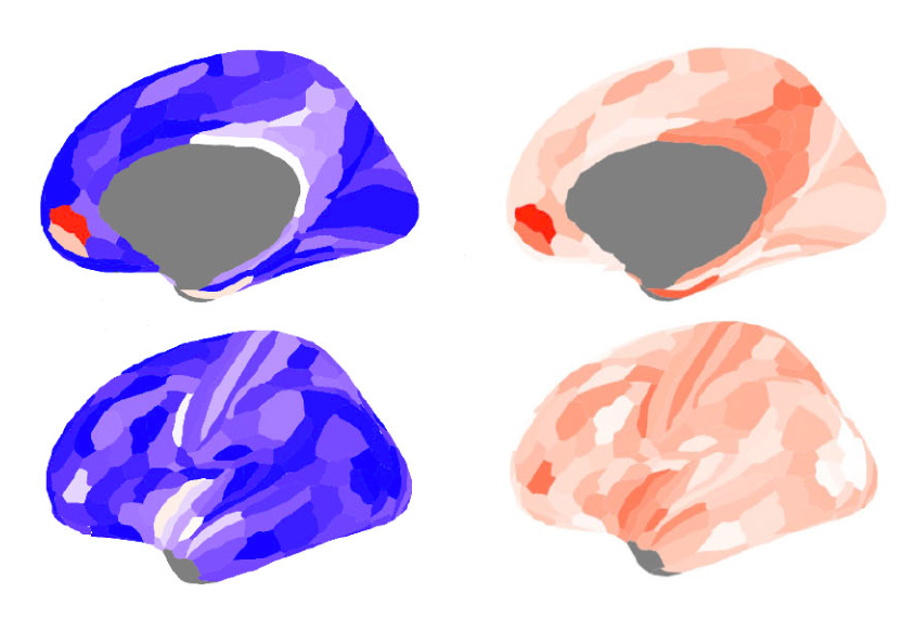 Brain images showing differences in signaling in autistic and normal brains.