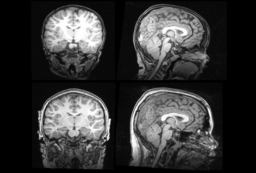 MRIs show changes over time