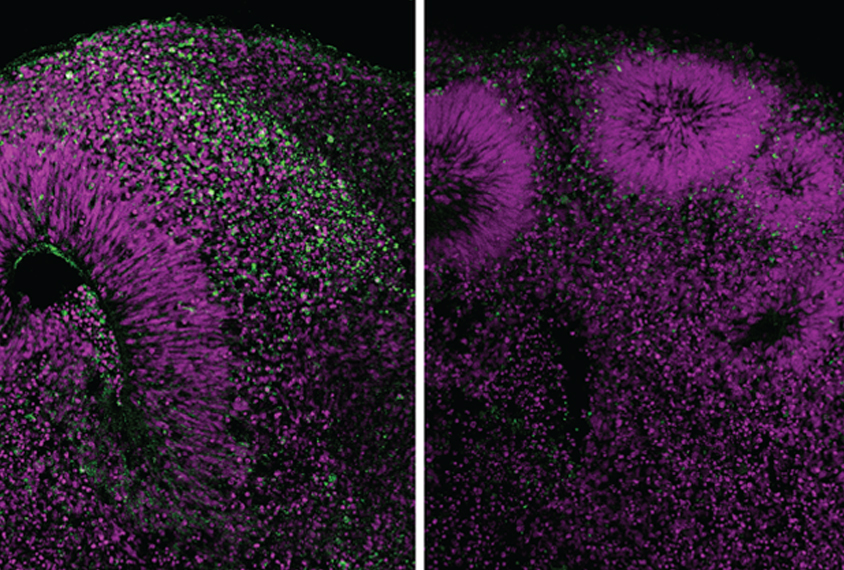 Brain organoids lacking a functional copy of a gene linked to microcephaly have lower levels of a structural protein (green) than do organoids with functional copies of the gene.