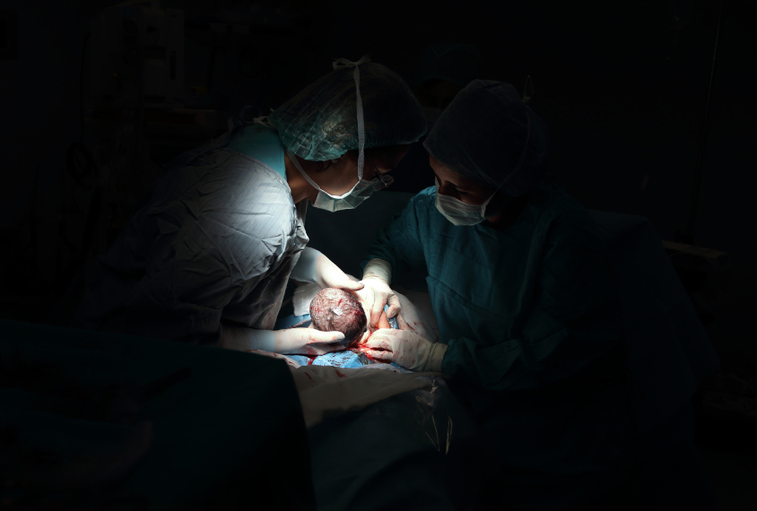 Operating room scene shows baby being guided out of belly of mother during a c-section.