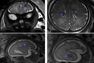 Fetail brain scans revealing lesions related to tuberous sclerosis.