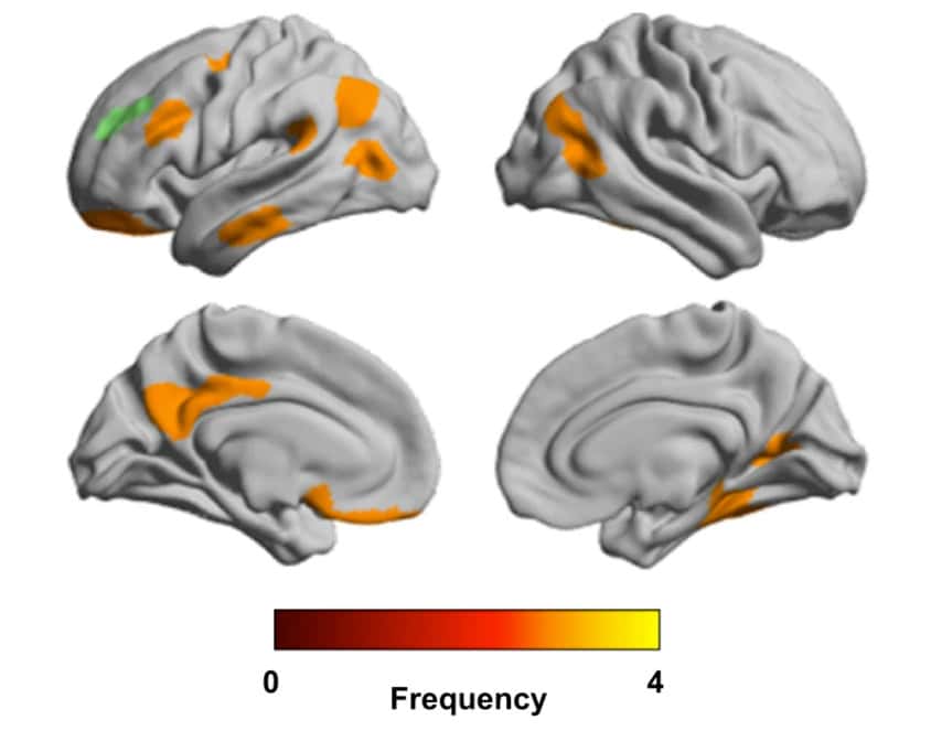 Brain images show structural differences in brain regions which track with autism traits.