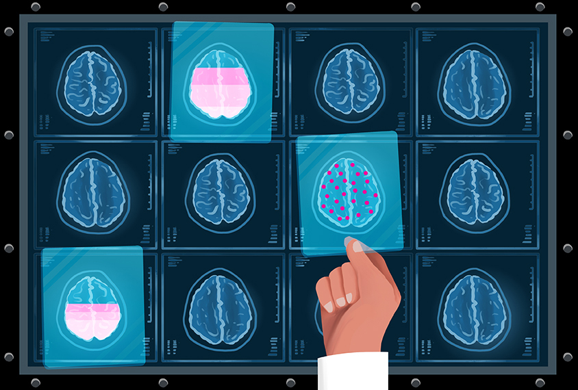 Differing serotonin levels in brain