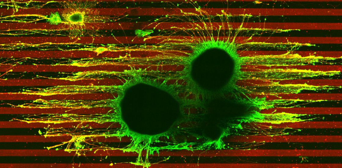 Micrograph of two developing axons, one with one copy of TSC2 gene and the other with two copies.