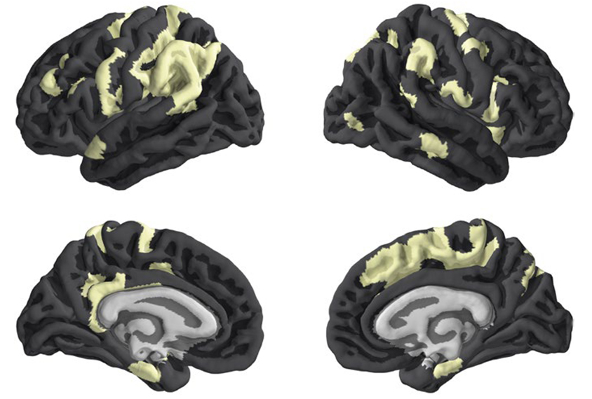 Four brains showing areas affected by the X chomosome in yellow