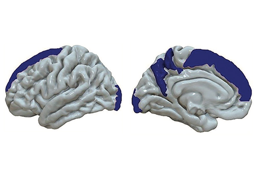 Color-coded brain images showing reduced thickness of superior frontal gyrus and other regions associated with presence of increased levels of inflammatory moleucle IL-6.