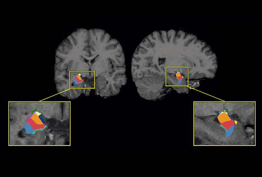 A brain scan displays images of the amygdala with different sections highlighted in blue, red, orange and other colors.