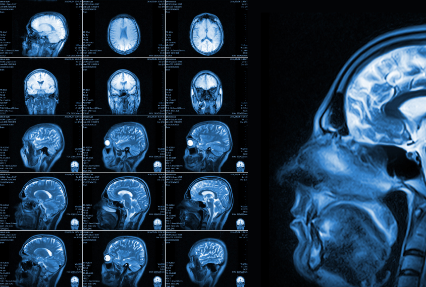 A large MRI scan of a human brain, with a grid of 15 smaller MRI scans to its left