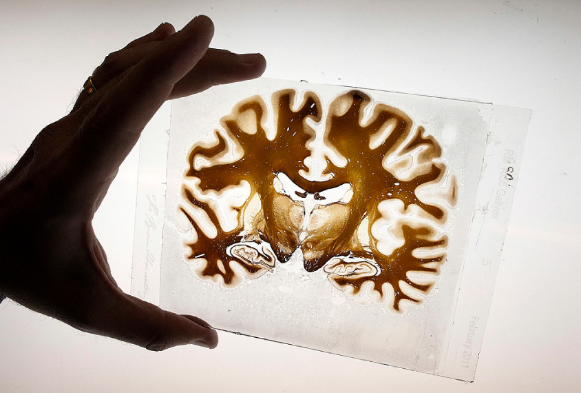 A sliced section of a human brain is displayed for a photograph.