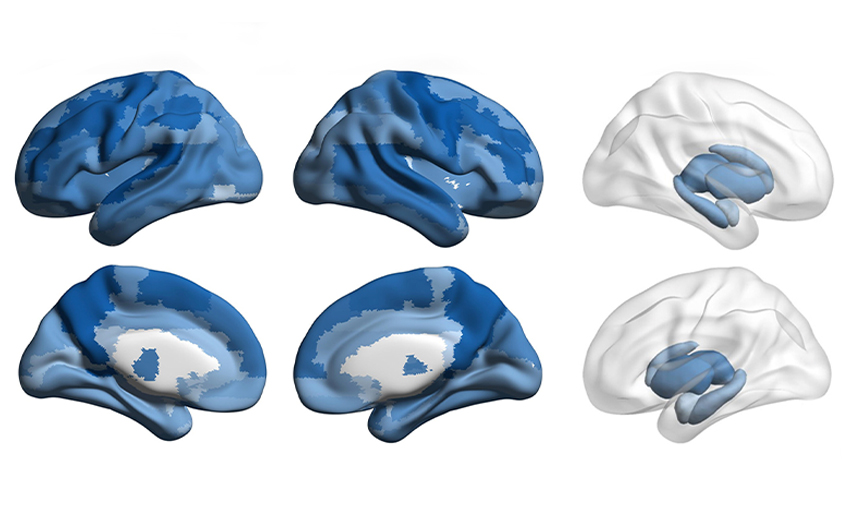 A grid of six brain scans showing white matter