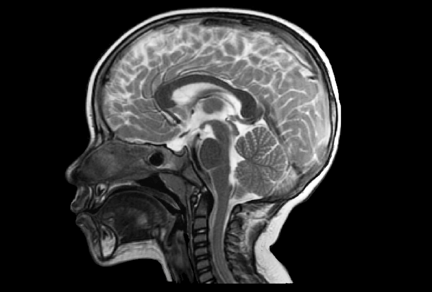 MRI scan of a 2-year-old child.