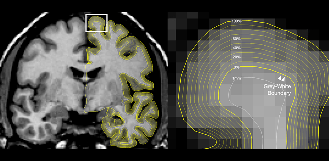 MRI scan with a section enlarged to display the scan's grey-white boundary.