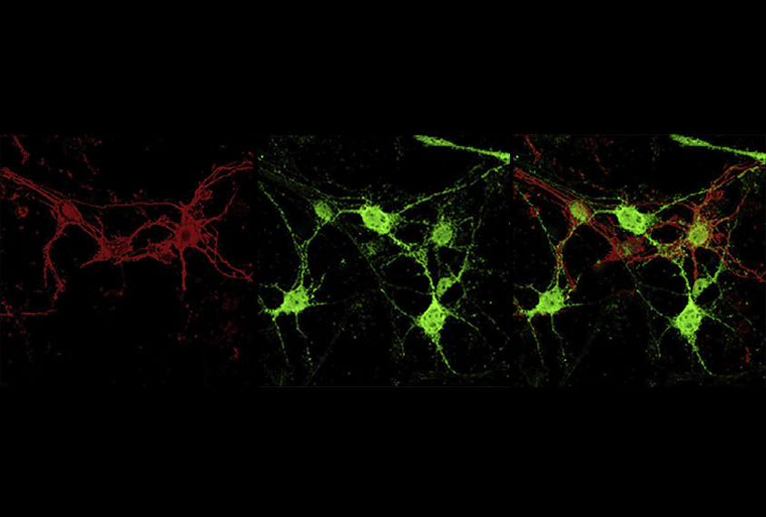 Adapted research image of immunofluorescence staining of primary cortical neurons showing expression of PTBP proteins and reduced level of the protein SYNGAP1.