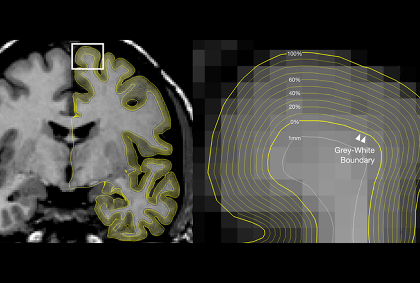MRI scan with a section enlarged to display the scan's grey-white boundary.
