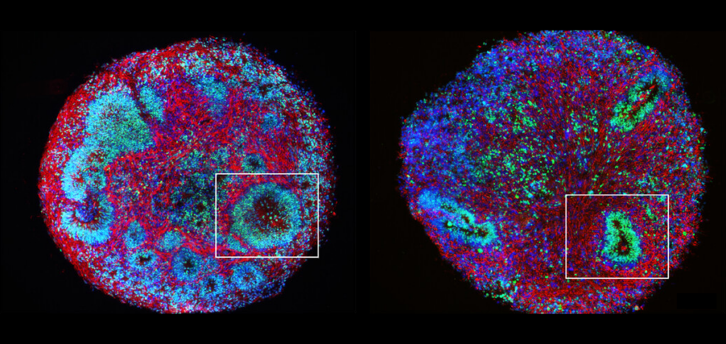 Two images of brain organoids demonstrating the effects of MeCP2 mutations.