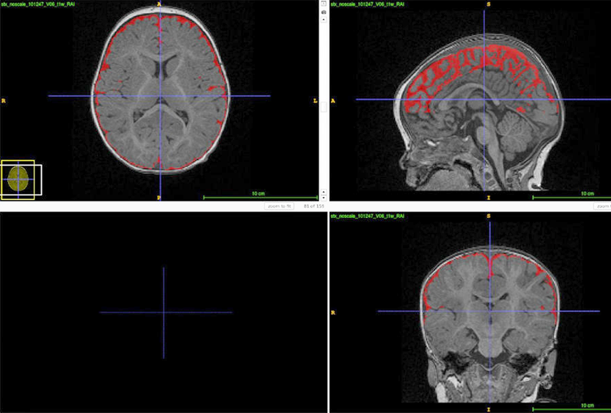 A grid of four brain scans showing excess cerebrospinal fluid.