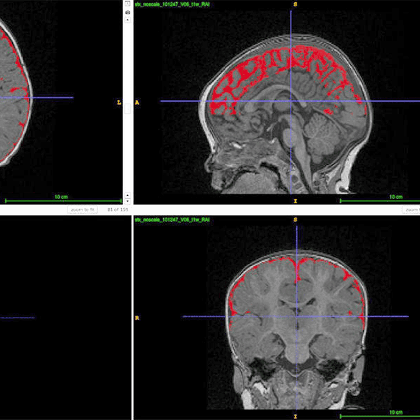 Is excess brain fluid an early marker of autism? episode artwork