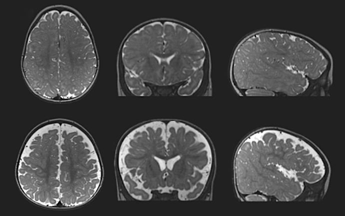 Brain scans from two infants with differing levels of CSF.