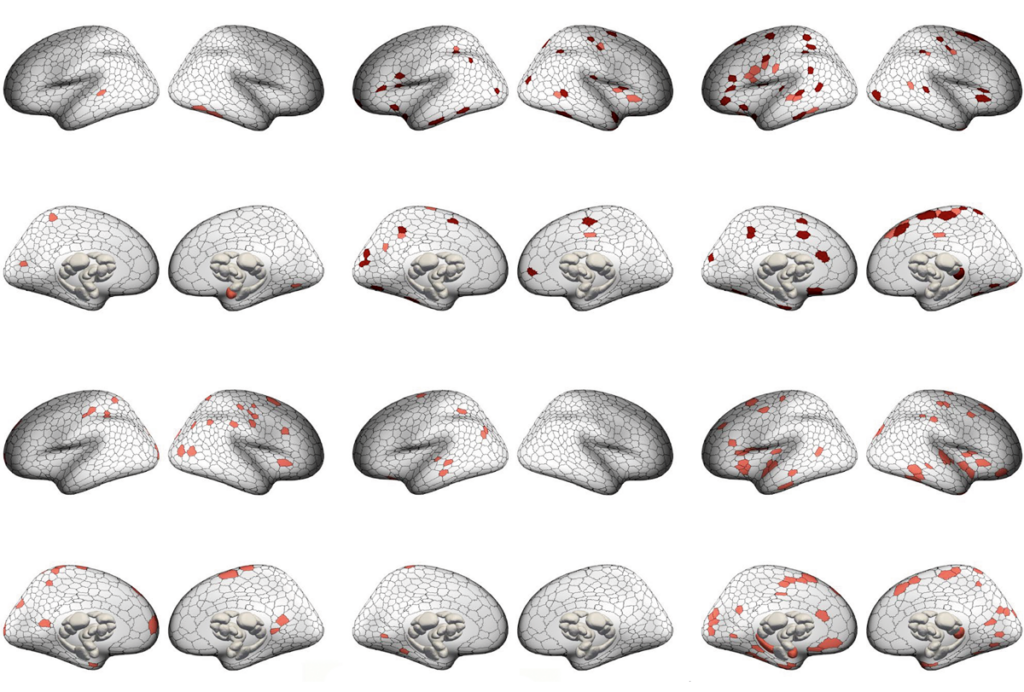 Research image of brain scans displaying gray-matter volume differences across across six psychiatric conditions.