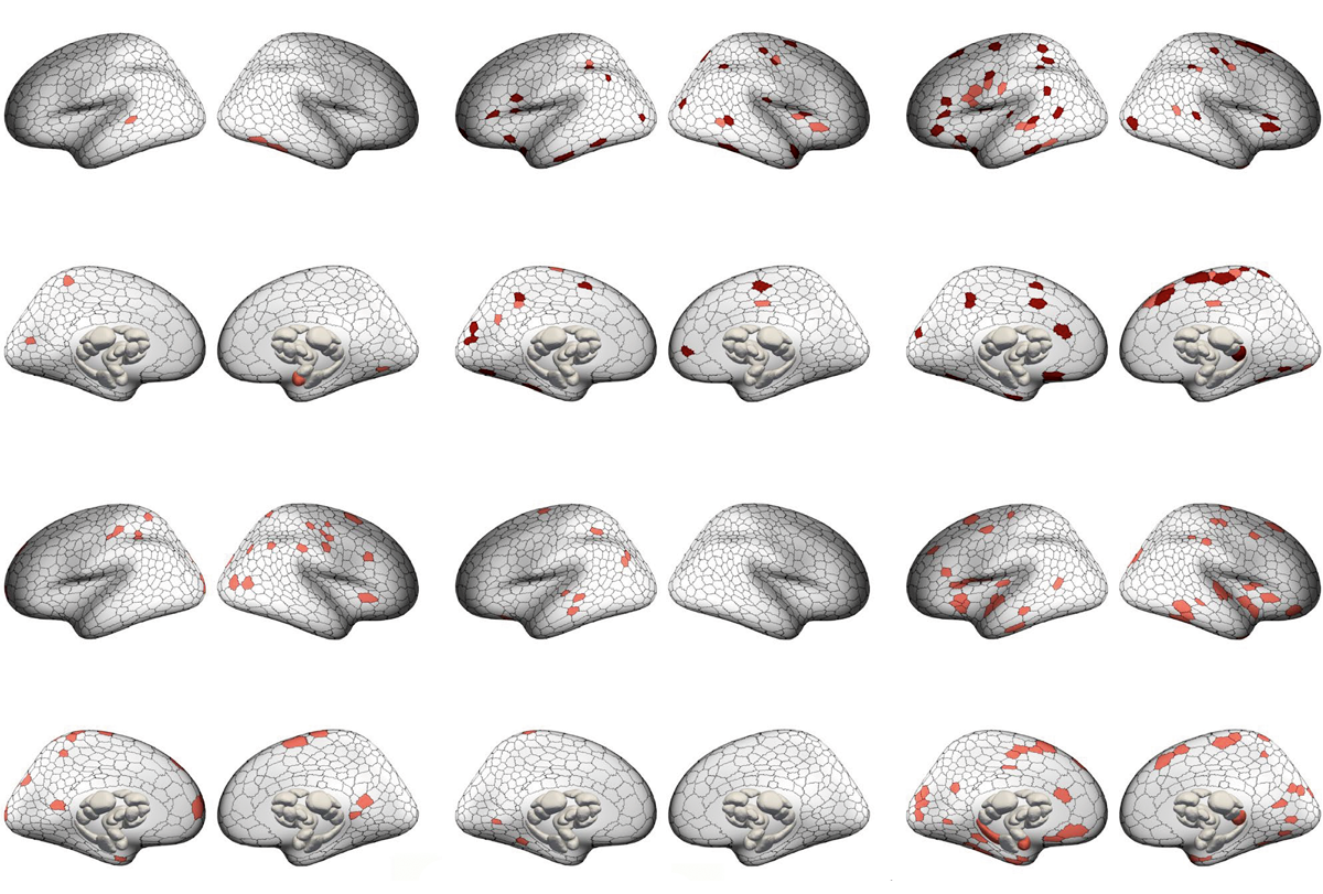 Research image of brain scans displaying gray-matter volume differences across across six psychiatric conditions.