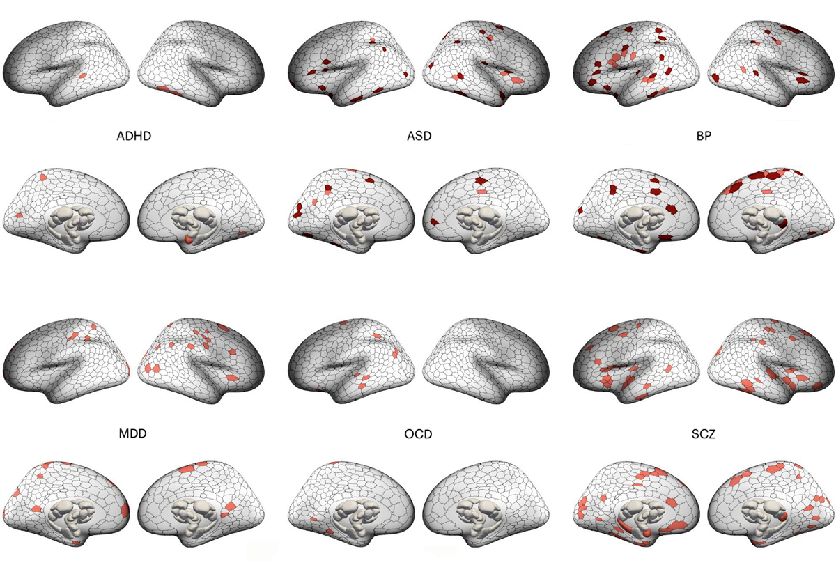 Research image of brain scans displaying gray-matter volume differences across across six psychiatric conditions.