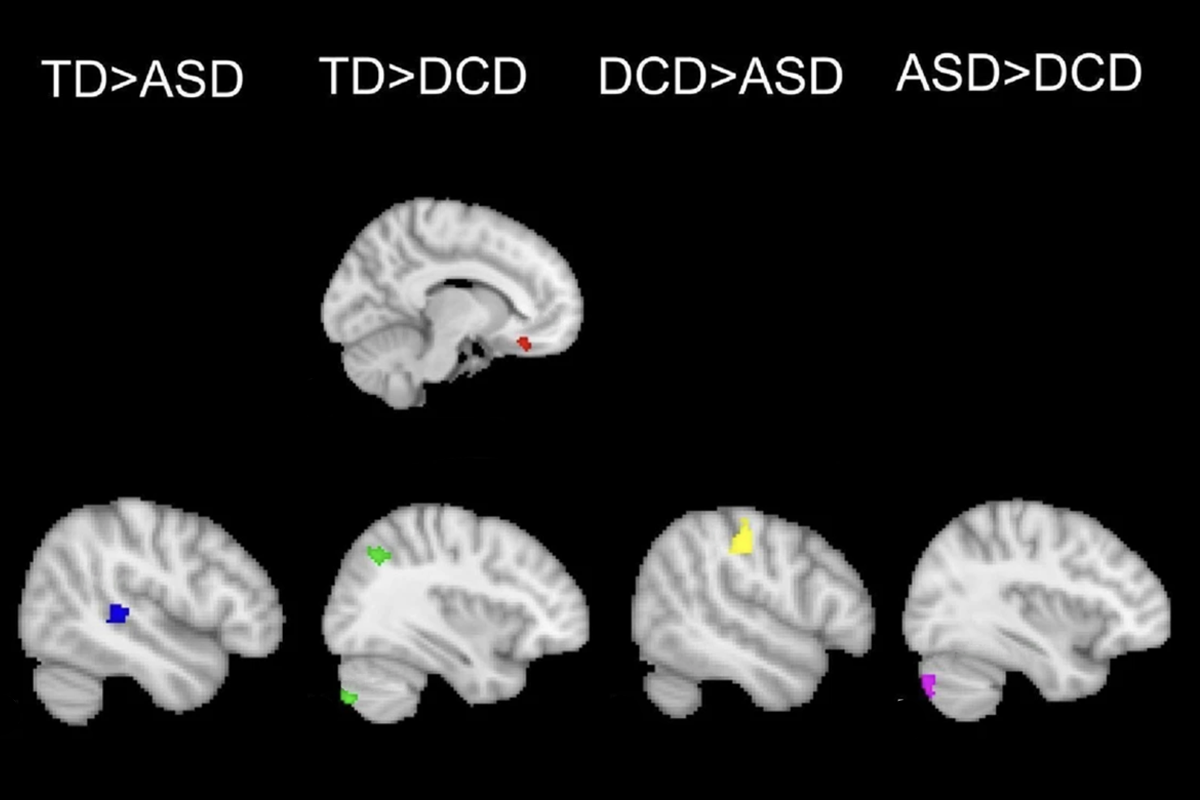 Research image of fMRI brain scans showing areas of brain activity when executing and imitating body movements.