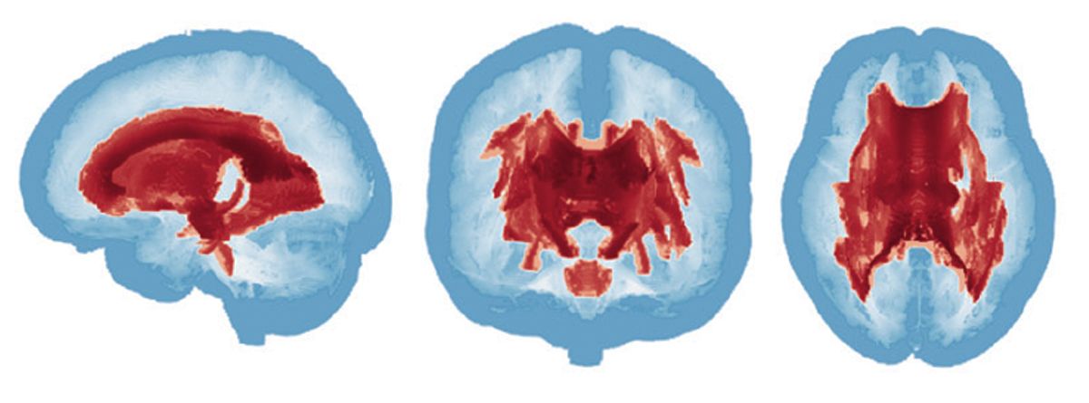 Research image of three brain scans.