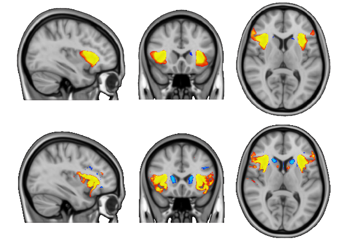 A set of brain scans showing gray-matter volume.