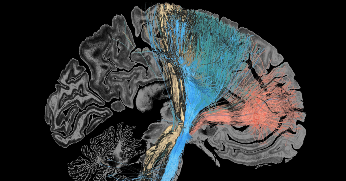 When Andreas Horn began researching brain disorders treated by deep brain stimulation (DBS) about 10 years ago, he says he also started to wonder abou