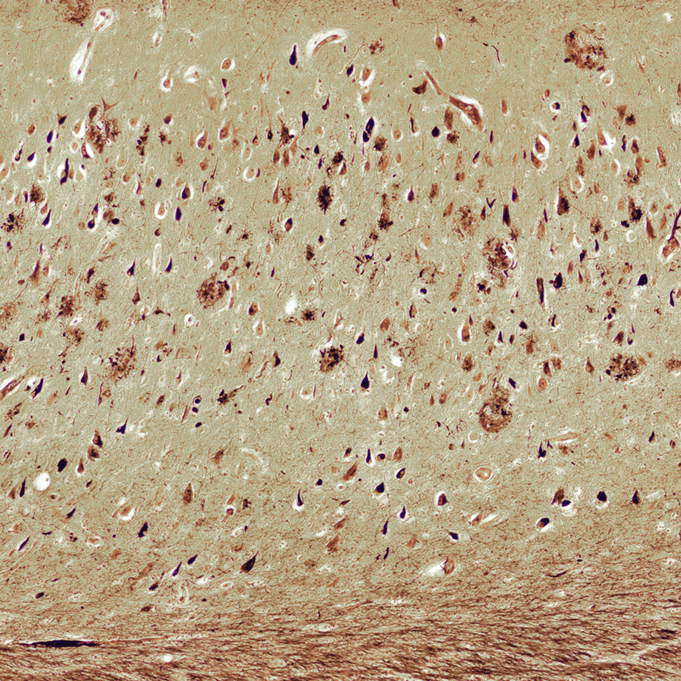 Reviving 'inside-out' hypothesis of amyloid beta to explain Alzheimer's mysteries episode artwork