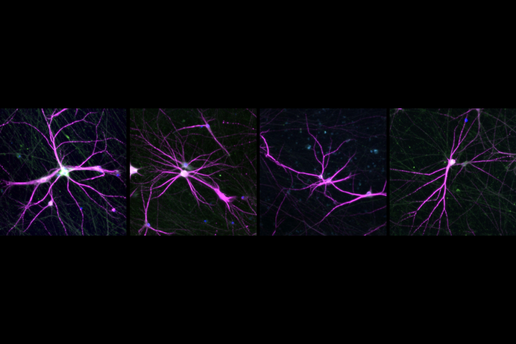 Research image of neurite overgrowth in cells grown from people with autism-linked PPP2R5D variants.