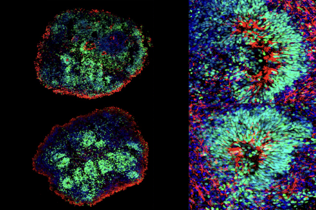 Research image of organoids from autistic people.