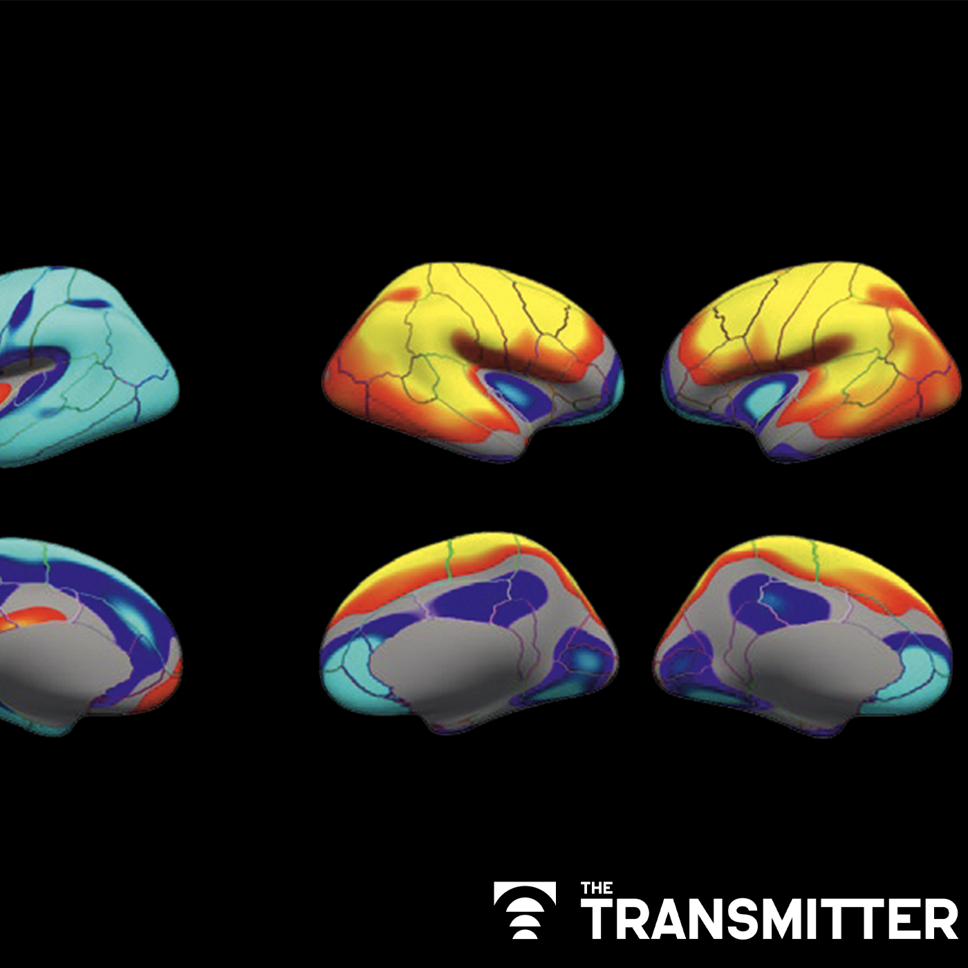 Poor image quality introduces systematic bias into large neuroimaging datasets