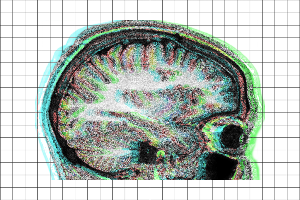 Brain scan with visual noise and glitch effects.